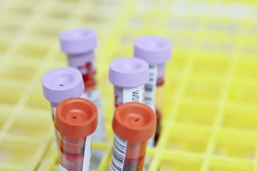 Understanding Liver Blood Tests