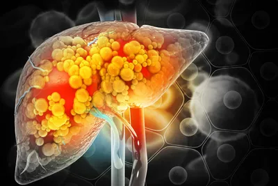 Early Detection of Fatty Liver Disease
