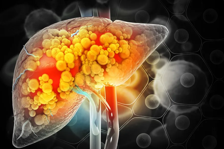 Early Detection of Fatty Liver Disease